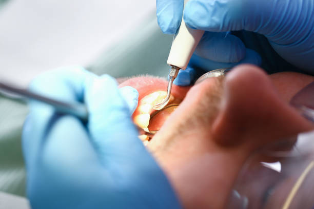 Best Emergency Dentist for Knocked-Out Tooth in Venetian Vlage, IL