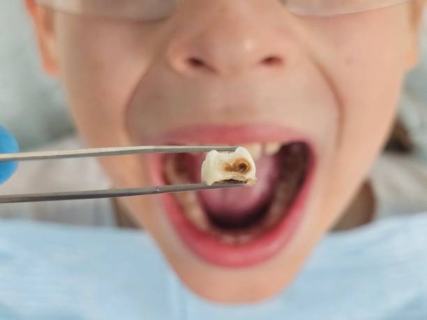 Best Emergency Dental Care for Abscessed Tooth in Venetian Vlage, IL
