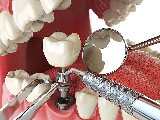 Best Emergency Root Canal Treatment in Venetian Vlage, IL